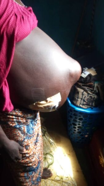 Help me else I’ll die – 40-year-old single mother appeals for help for surgery
